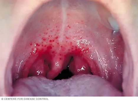 Streptococcus pharyngitis A strep throat Disease